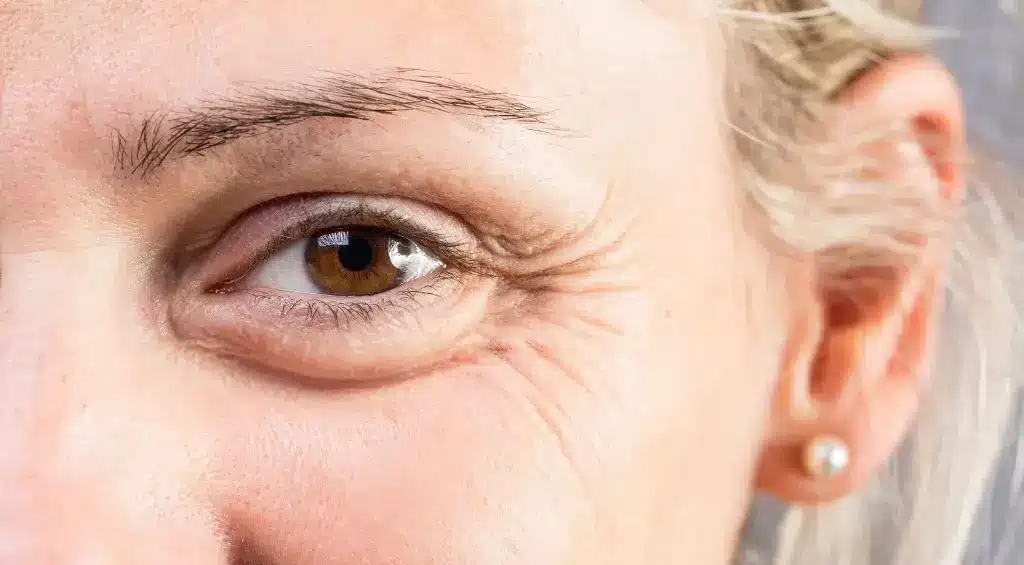 Elimine Bolsas nos Olhos Rápido