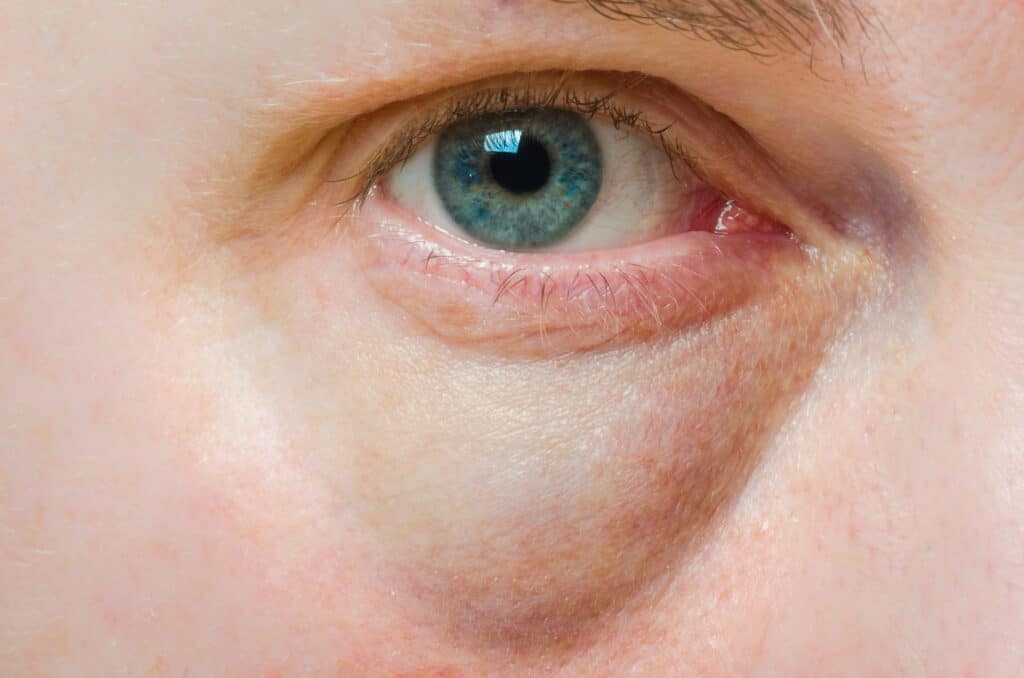 Elimine Bolsas nos Olhos Rápido