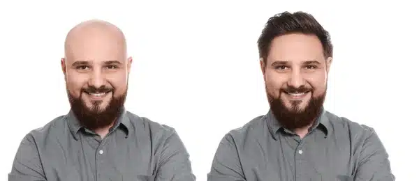 Creme de Ervas: Combate à Calvície
